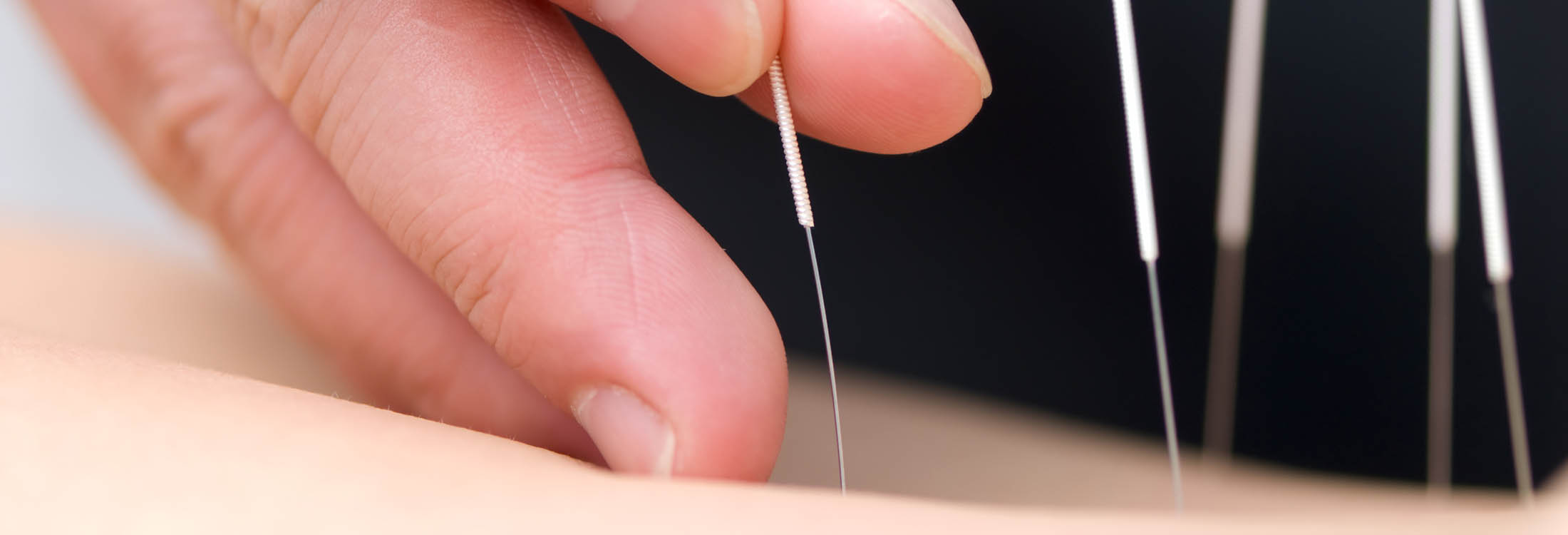 Dry Needling bij Fysiotherapie Paans