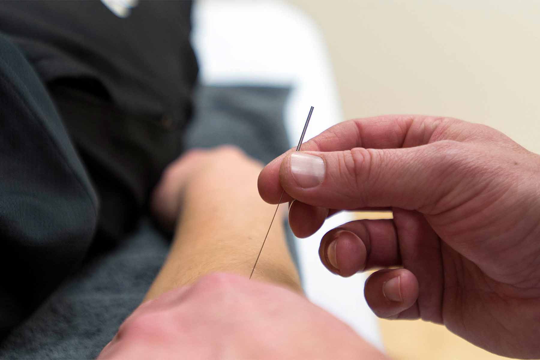 dry needling